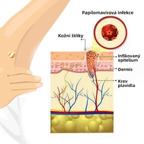 Wree - gel na odstranění fibromů, bradavic a jiných výrůstků - 8